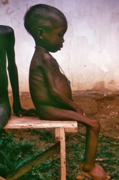 Childhood Malnutrition Prevention